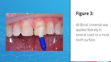 All Bond Universal Total Etch Case