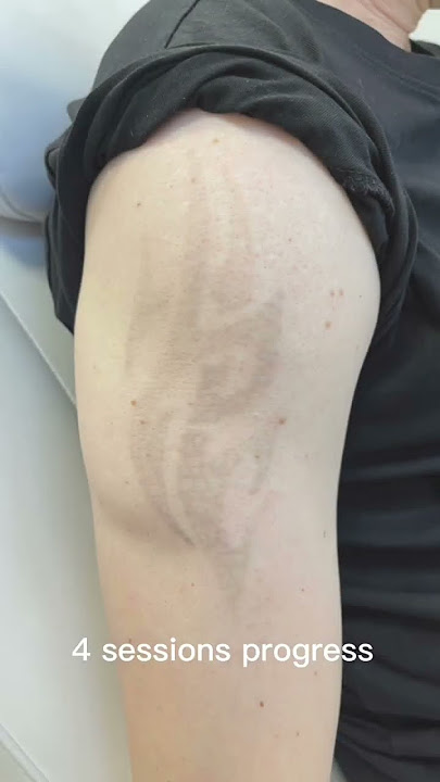 Laser tattoo removal results #lasertattooremoval #beforeandafter #skincare #tattoos #satisfying