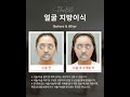 #더비비성형외과 사라진 볼륨은 채우고, 자연스러움은 그대로
