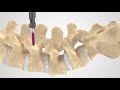 MAS Fixation Patient Education Animation