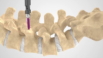 MAS Fixation Patient Education Animation