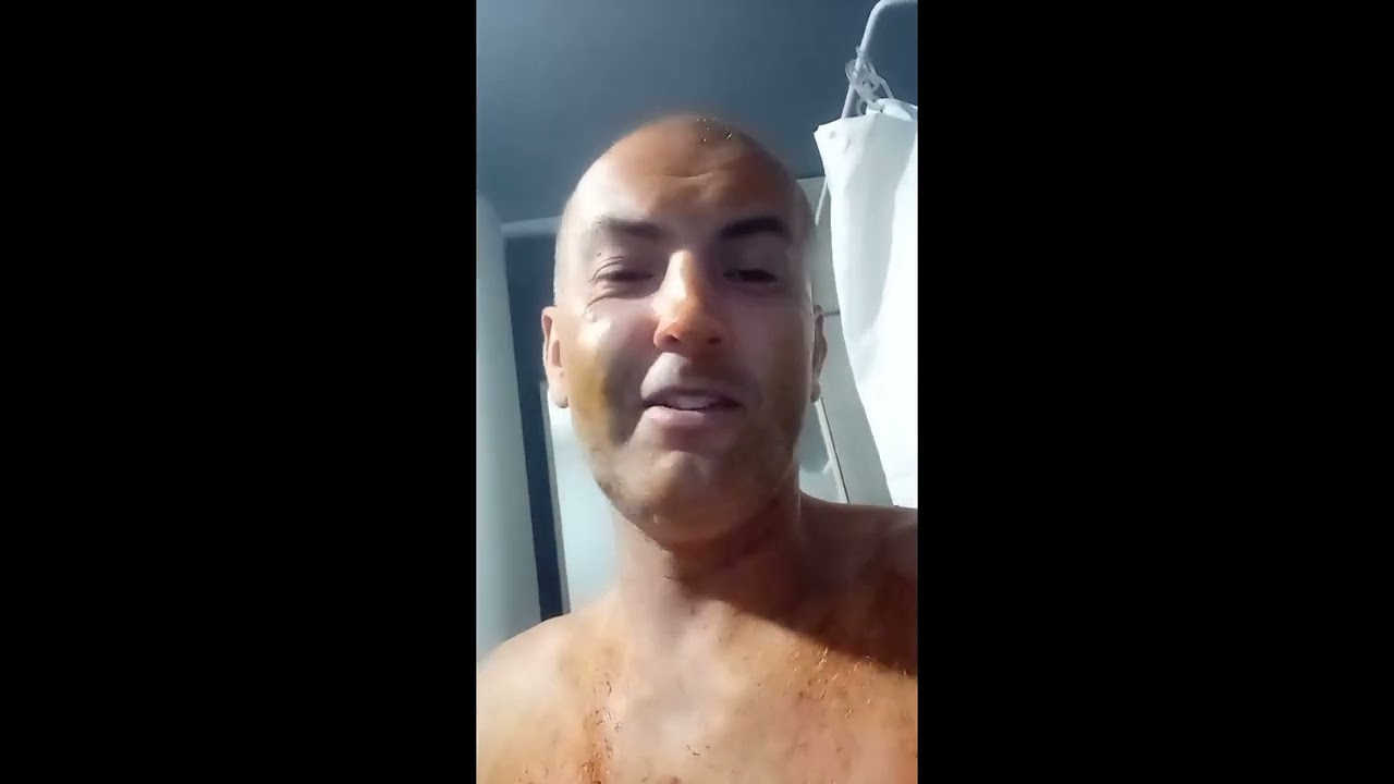 Сербия ветрянка в 39 лет повторно заболел