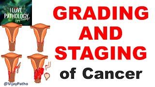 NEOPLASIA Part 11: GRADING and STAGING of cancer