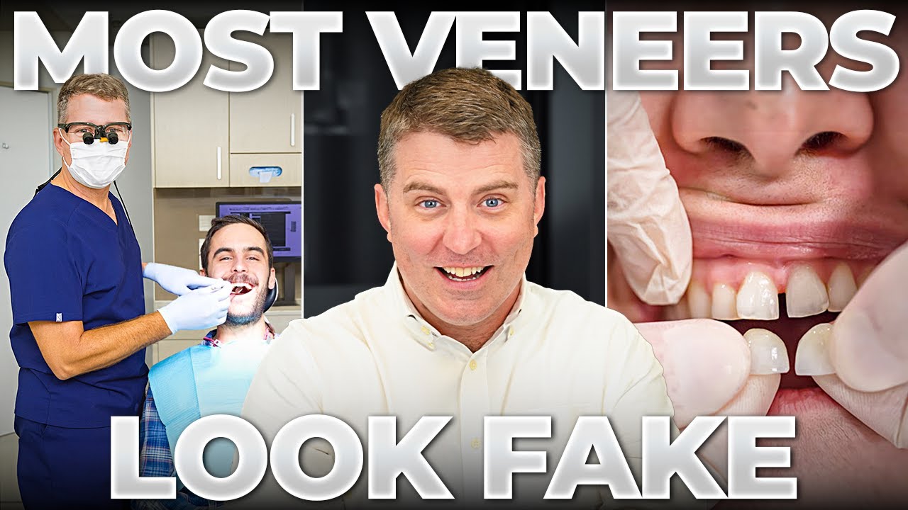 I've Done 1000 Veneers, This Is Why People Hate Their Results