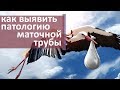 Проходимость маточных труб. 🕸 Как делают проверку проходимости маточных труб. Моситалмед