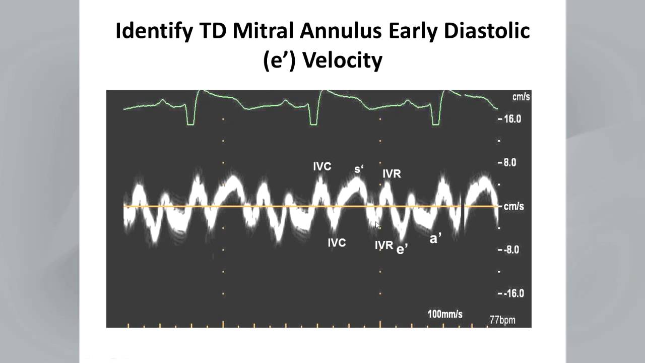 Recommendations for the Evaluation of LV Diastolic Function - YouTube