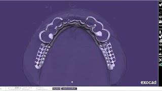 Exocad partial framework design -Style GONJO