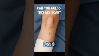 Can You Guess This ACL Scar? | Hamstring Tendon Graft Explained (Part 3)