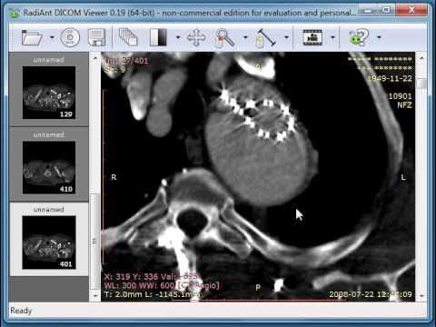 Dicom снимки. Dicom снимки. Radiant dicom viewer. Dicom viewer 3. Радиант программа мрт.