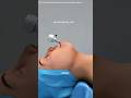 How thyroidectomy is done (3D animation) #drone #anatomy #slipdiscsurgery #rotatorcuff #lithotomy