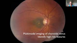PAOOS WEBINAR - CAROL SHIELDS MD (USA) - HAREM KREMA MD (CANADA), JULY 2020.