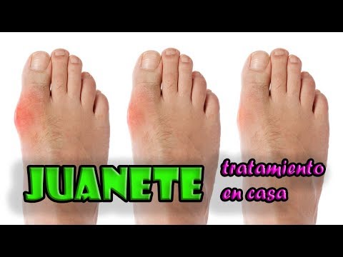 Como quitar los juanetes