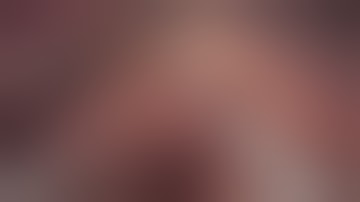 Laparoscopic segment 6 liver resection for epithelioid hemangioendotelioma