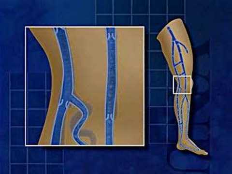 Learn how varicose veins can be caused. (A video from Beth Israel Deaconess Medical Center, Boston)