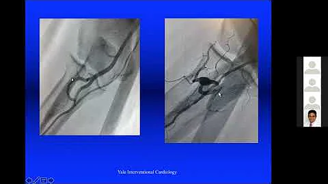 Radial Access introduction. Dr Steven Pfau. July 21 2021