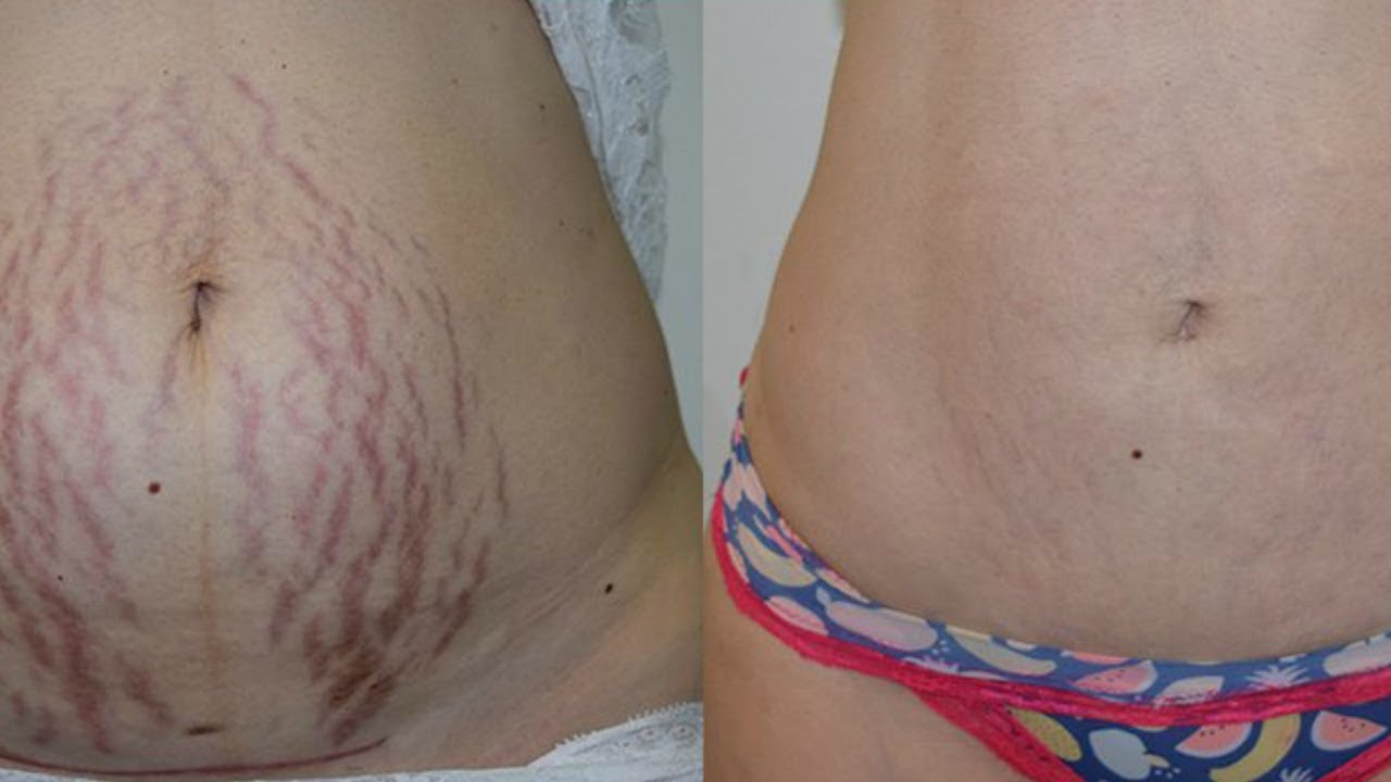 Remove your stretch marks within 8 weeks  || Soumali