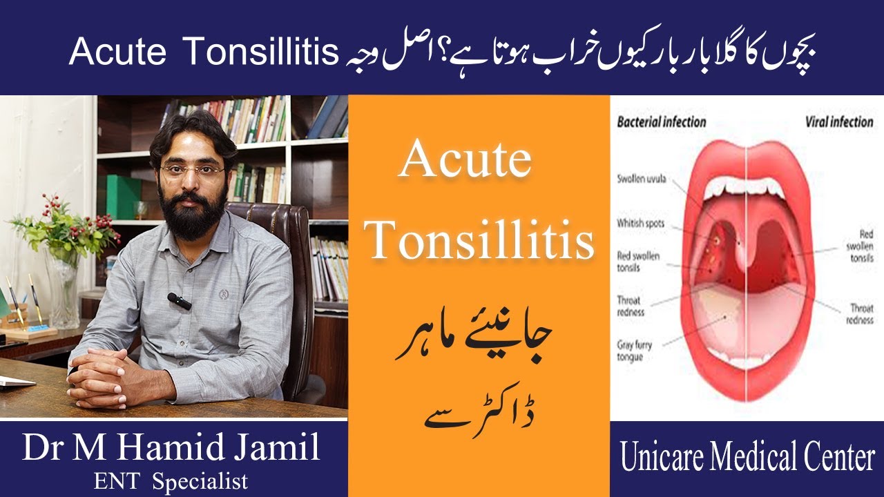 Acute and chronic tonsillitis ENT |  Acute Tonsillitis Explained | Unicare Medical Center