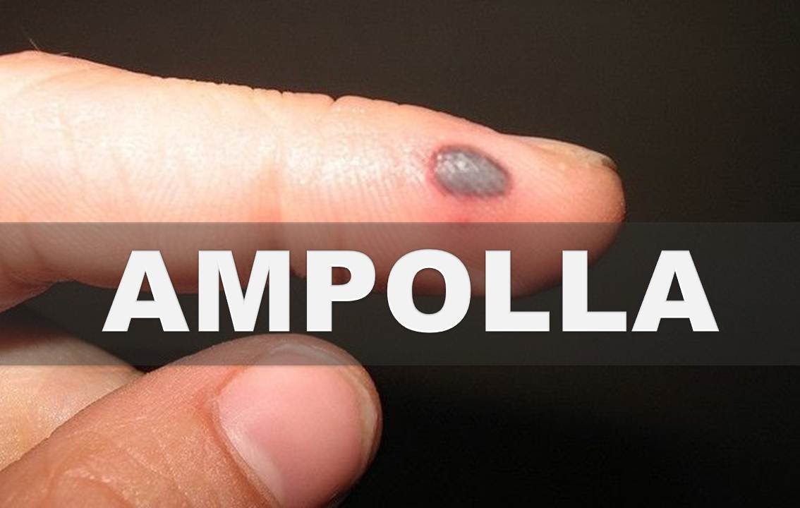 Como deshacerse de las ampollas de sangre en casa con métodos efectivos