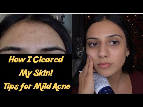 HOW I GOT RID OF MY MILD ACNE/FOREHEAD BUMPS... + SHAVING MY FACE? | *EASY & QUICK* SKINCARE 