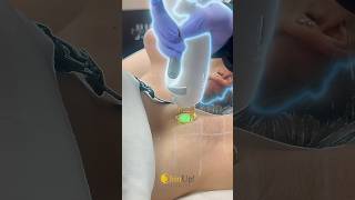 Candela Laser Hair Removal Treatment