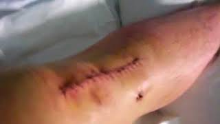 Victorian Knee Surgery - Scar post ACL reconstruction