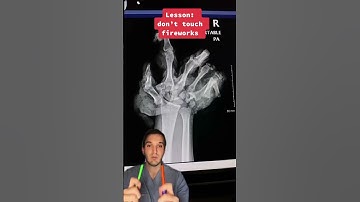 4th of July fireworks injury x-rays