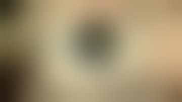 Brunescent PXS cataract with phacodonesis: cataract surgery with iStent by Steven G. Safran MD