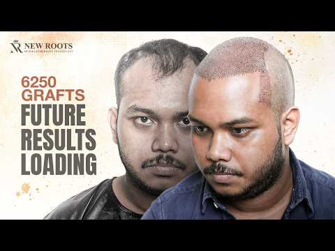 A Big Hair Transformation Begins! 😀 | 6000+ Grafts | Hair Transplant in Kolkata | New Roots