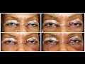 Part 2: Hooded Eyelid Surgery | Blepharoplasty | Day 1 - 8 Post-op