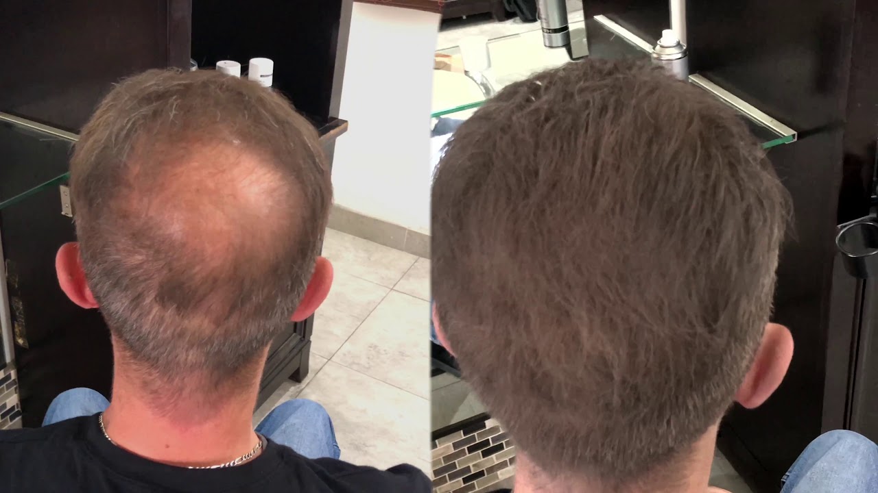 Toppik Hair Fiber vs HairCubed3 Amazing Video Thinning Hair in the front and back ! YouTube