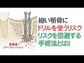 インプラントの周囲に必要な骨量と人工骨による骨造成の不確実性とは #インプラント #OAM大口式 #入れ歯