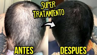 Repoblar CUERO CABELLUDO en 4 MESES 🔥RESULTADOS con MINOXIDIL🔥 | Tratamiento Alopecia