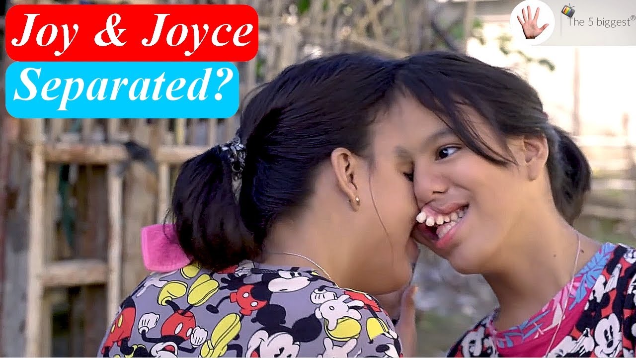 Conjoined Twins Joy and Joyce Magsino Separated? Body Bizarre! YouTube