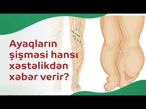 Video: İstidə əllər şişir?