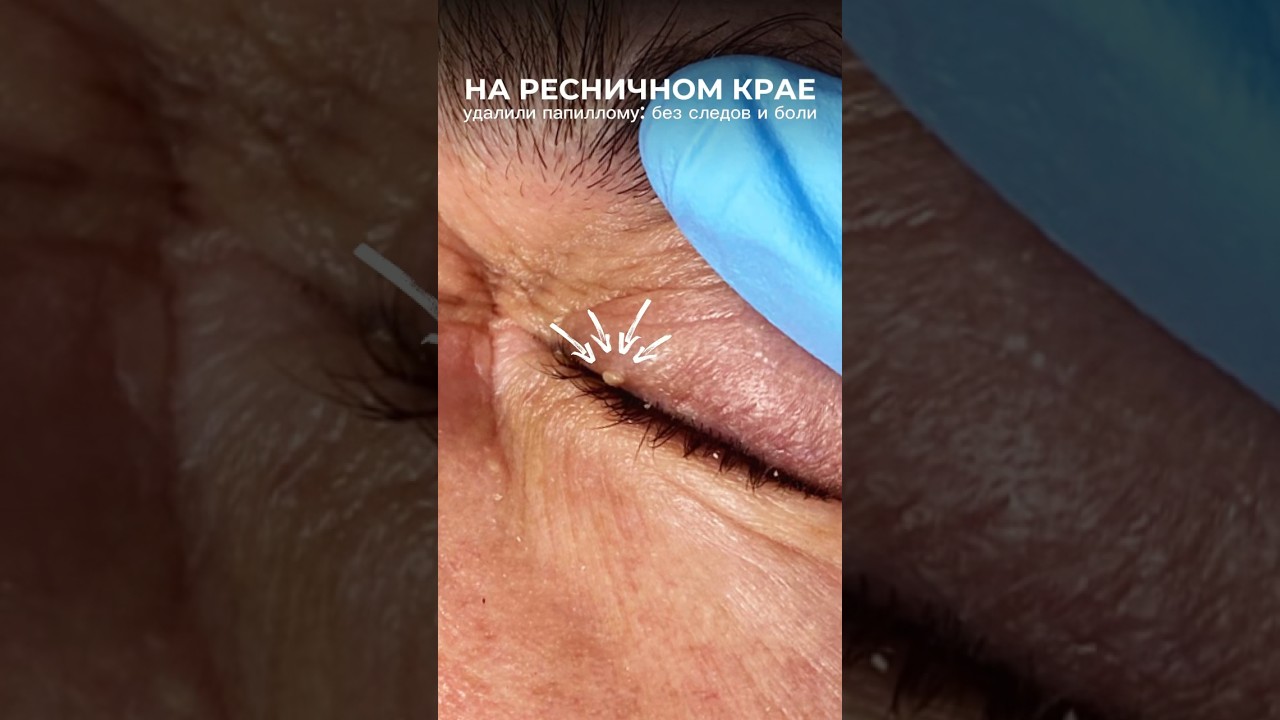 Папиллома на глазу. #косметолог #дерматолог #допосле #skintags #skintagremoval #beforeandafter #fyp