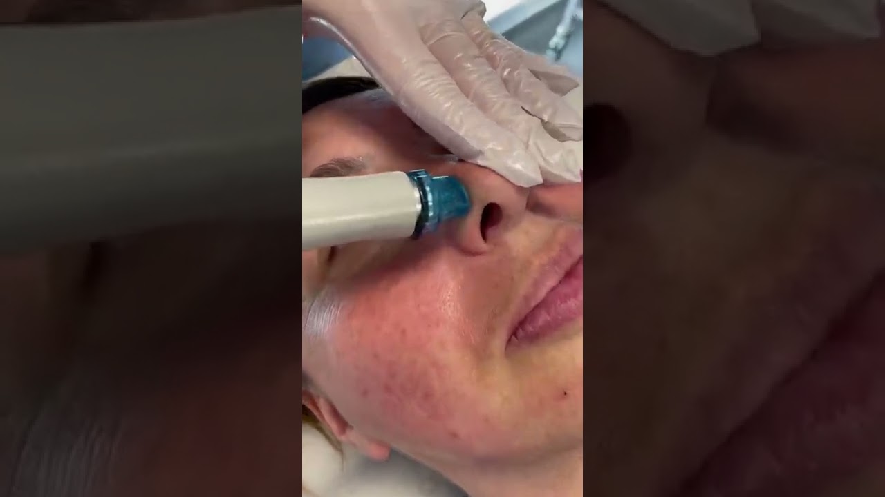 HydraFacial Vortex Fusion Facial