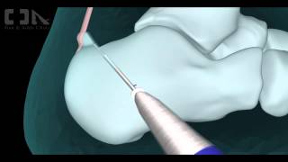 Minimally Invasive Haglunds Deformity Surgery