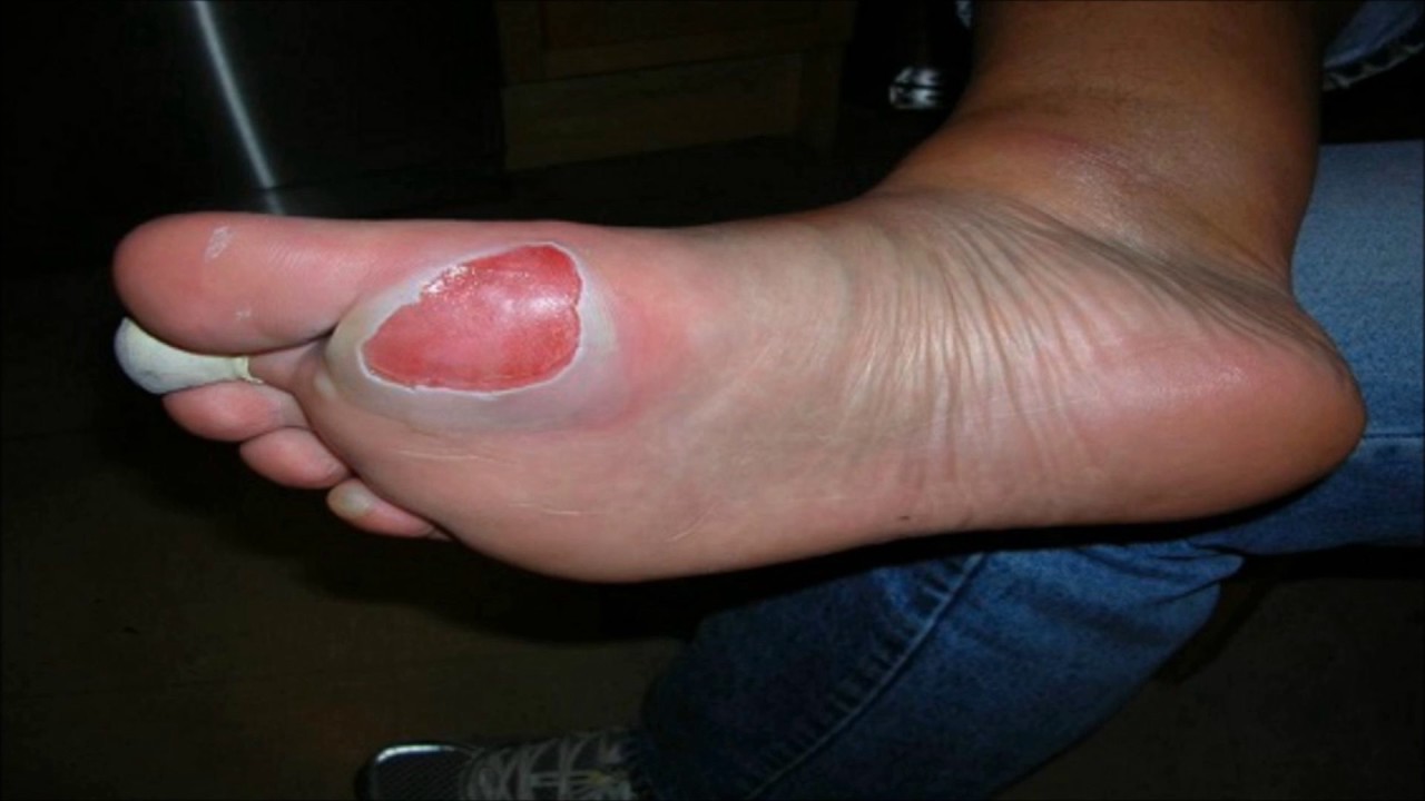 HOW TO GET RID OF FOOT BLISTERS IN NO TIME 