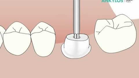 ANKYLOS TitaniumBase bietet patientenindividuelle Ästhetik