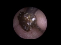 'Tympanoslerotic' Eardrum revealed after E-suction®  - Mr Neel Raithatha (The Hear Clinic)