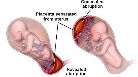 Placental abruption placenta partially or completely separates from the uterine wall before delivery