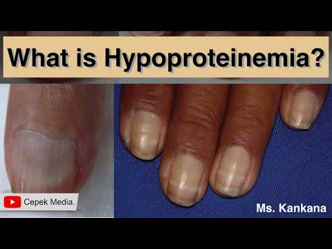 Video: Hipoproteinemija: Definicija, Vzroki In Simptomi