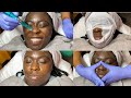 Microneedling Facial Treatment | GlamByLiaLeigh
