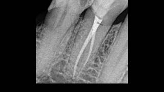 RCT ofandibular first  premolar with two canals#premolar #endo #rootcanal #rct