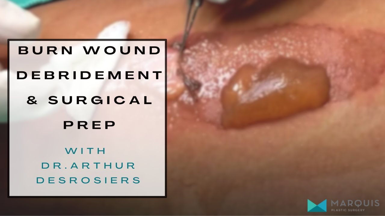Burn Debridement