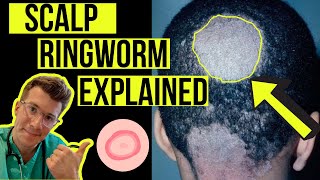 Doctor explains Scalp Ringworm (Tinea Capitis) including causes, symptoms, treatment \& more!