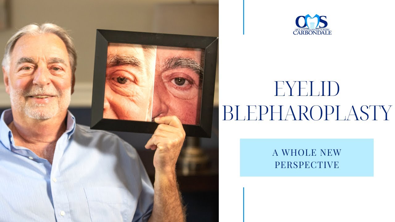 All I Wanted To Do Was Be Able To See – My Upper Eyelid Surgery With Dr ...