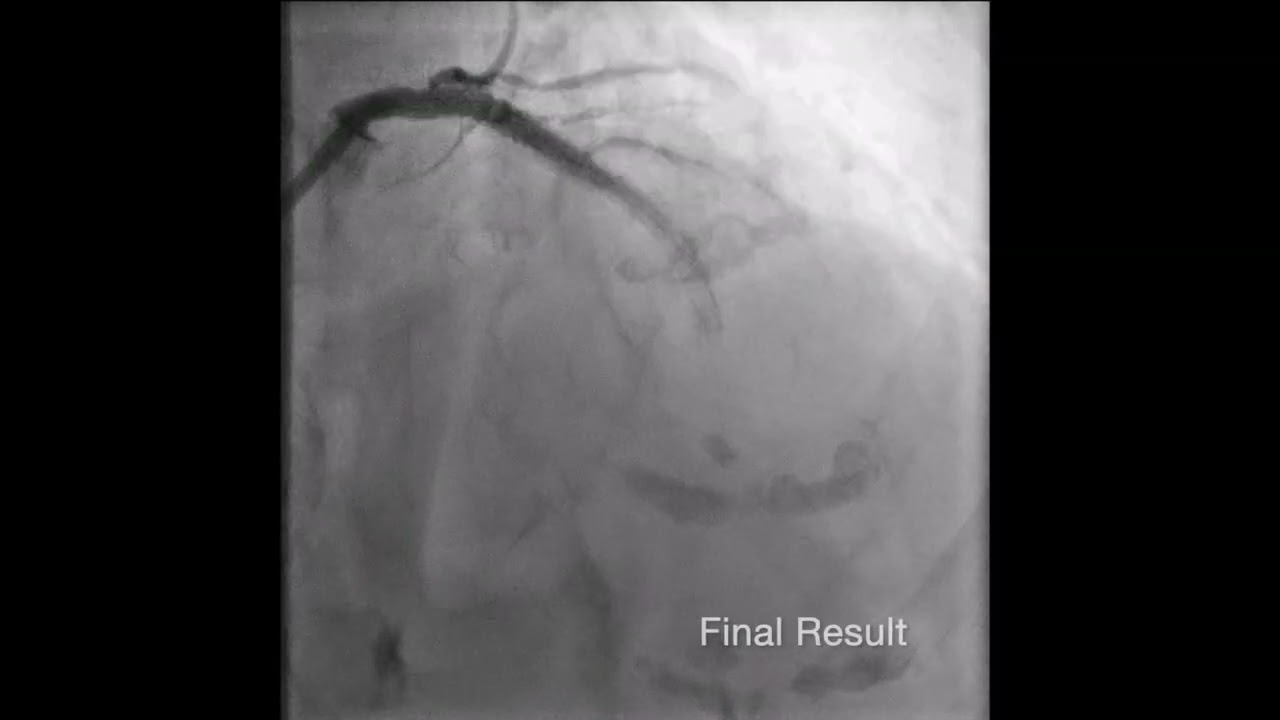 DES PCI with Ultimaster Nagomi DES