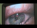 The Operation - Eye Witness Laser Eye Surgery Day 1a picture