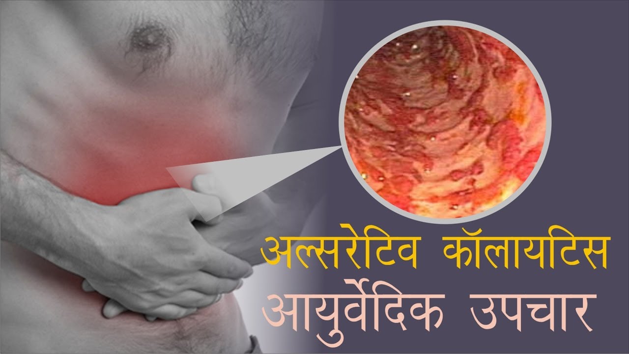 Watch Video Ulcerative Colitis Permanent Cure at Planet Ayurveda - Mohali